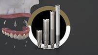 NeoArch Implant Lines