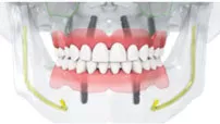 Novaloc® Retention System- Tissue Level Implants (TL)