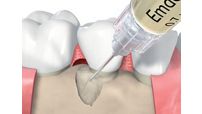 Cirurgia periodontal