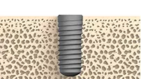 Bone Level/Bone Level Tapered (BL/BLT)