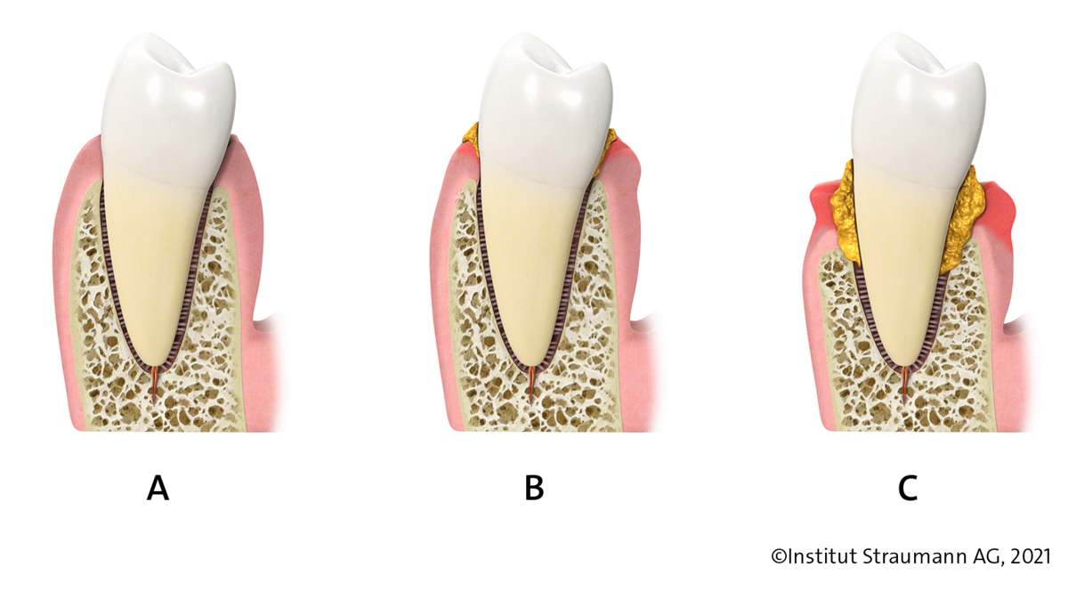 Different stages of gum disease