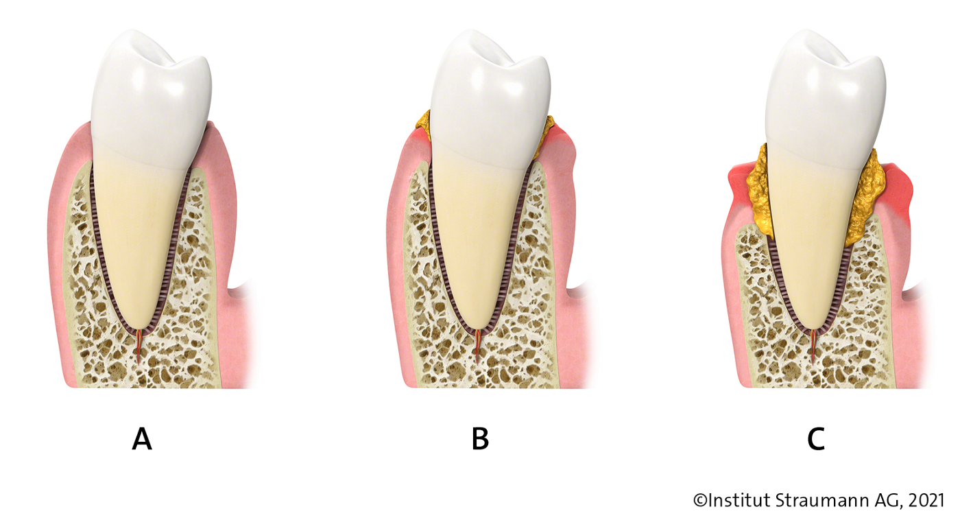 Different stages of gum disease