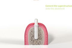 straumann ceramic implant systems