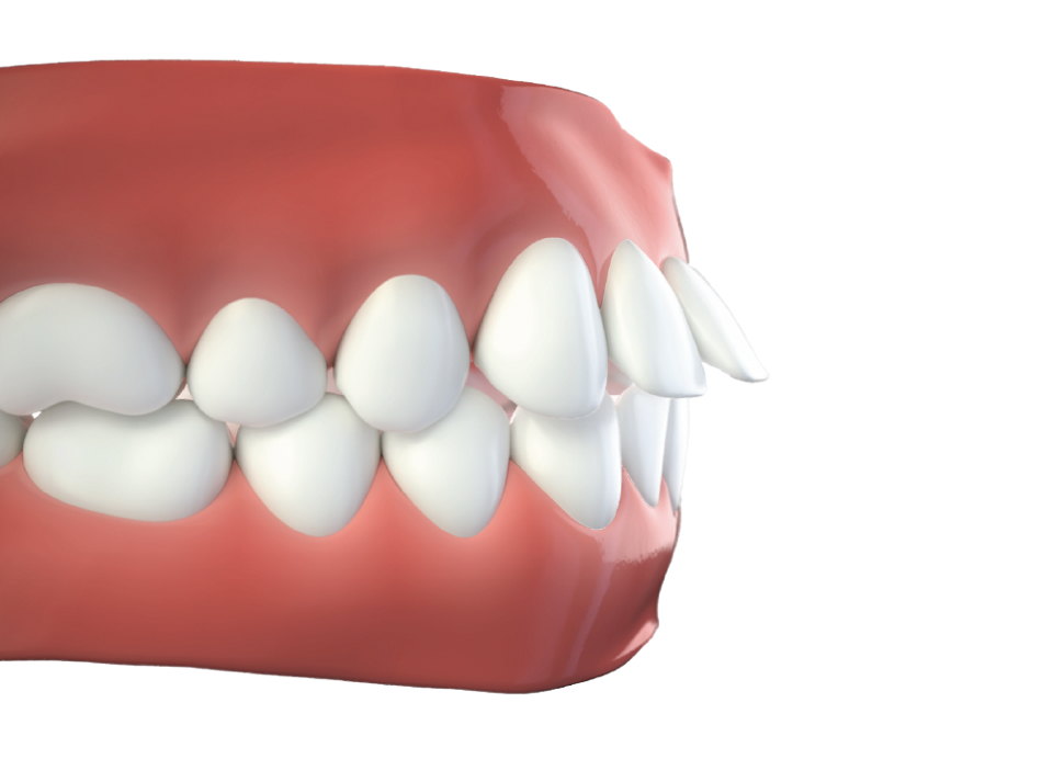 Overjet and Overbite: A Clear Aligner Guide - ClearPath Orthodontics