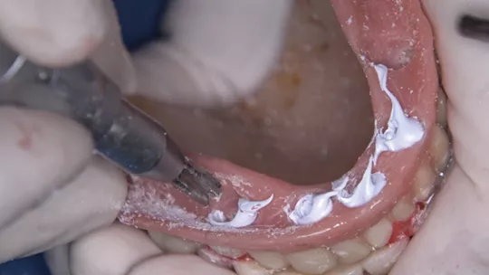 Internal wear of the prosthesis for the coping niches creation. 