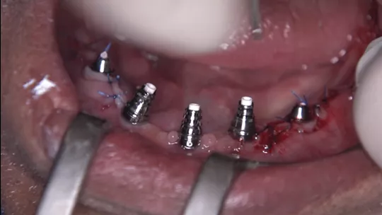 Installation of the Mini Conical Abutment Coping NeoConvert over the Mini Conical Abutments.