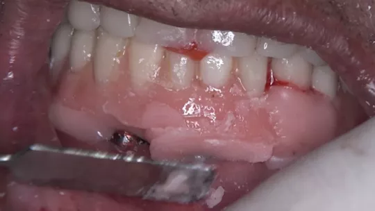 Bonded prostheses placed in the mouth, waiting for the final setting time of the acrylic resin. 