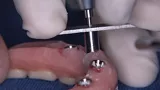 Use of the Drill Guide For Handpiece 1.5mm NeoConvert positioned on the internal part of the prosthesis and fitting into the base of the coping to perform the drilling in the direction from the internal to the external portion of the prosthesis.