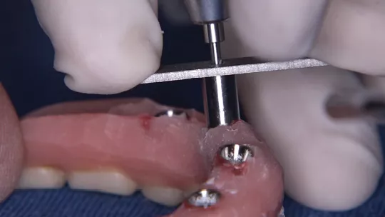 Use of the Drill Guide For Handpiece 1.5mm NeoConvert positioned on the internal part of the prosthesis and fitting into the base of the coping to perform the drilling in the direction from the internal to the external portion of the prosthesis.