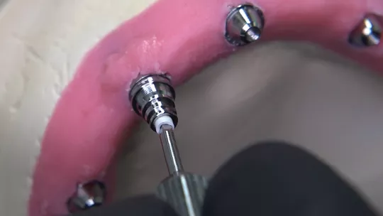 Installation of the Mini Conical Abutment Coping NeoConvert, fixed by Pin Capture NeoConvert.