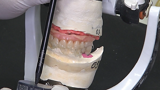 Capture of the Mini Conical Abutment Coping NeoConvert by articulating the upper model with the denture filled with acrylic resin and bonded to the antagonist.