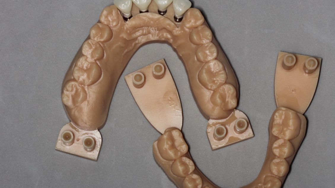 Printed model with implant replicas positioned according to the treatment planning