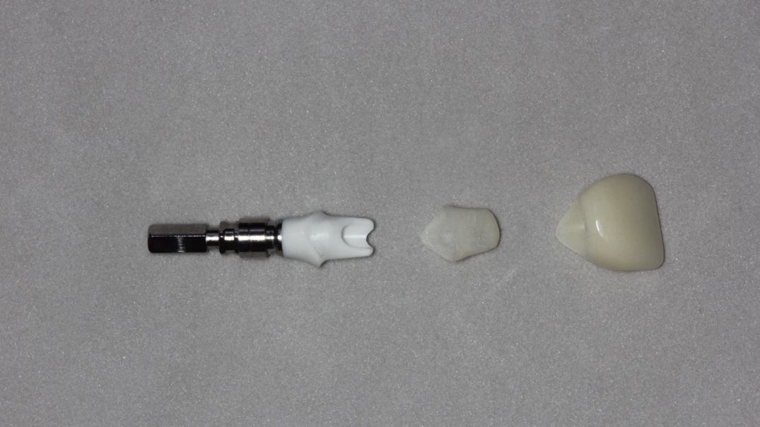 Temporary crowns and final customized zirconia abutments were also produced and adjusted in this model