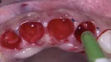 Teeth extraction with a minimum trauma