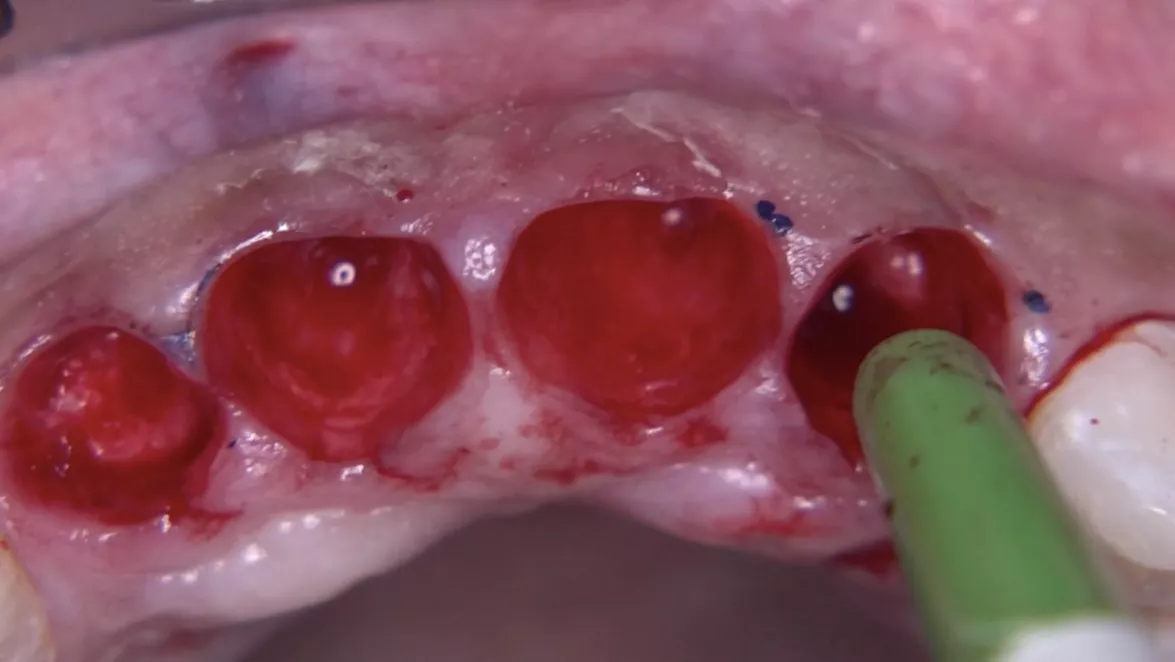 Teeth extraction with a minimum trauma