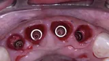 Final implant position