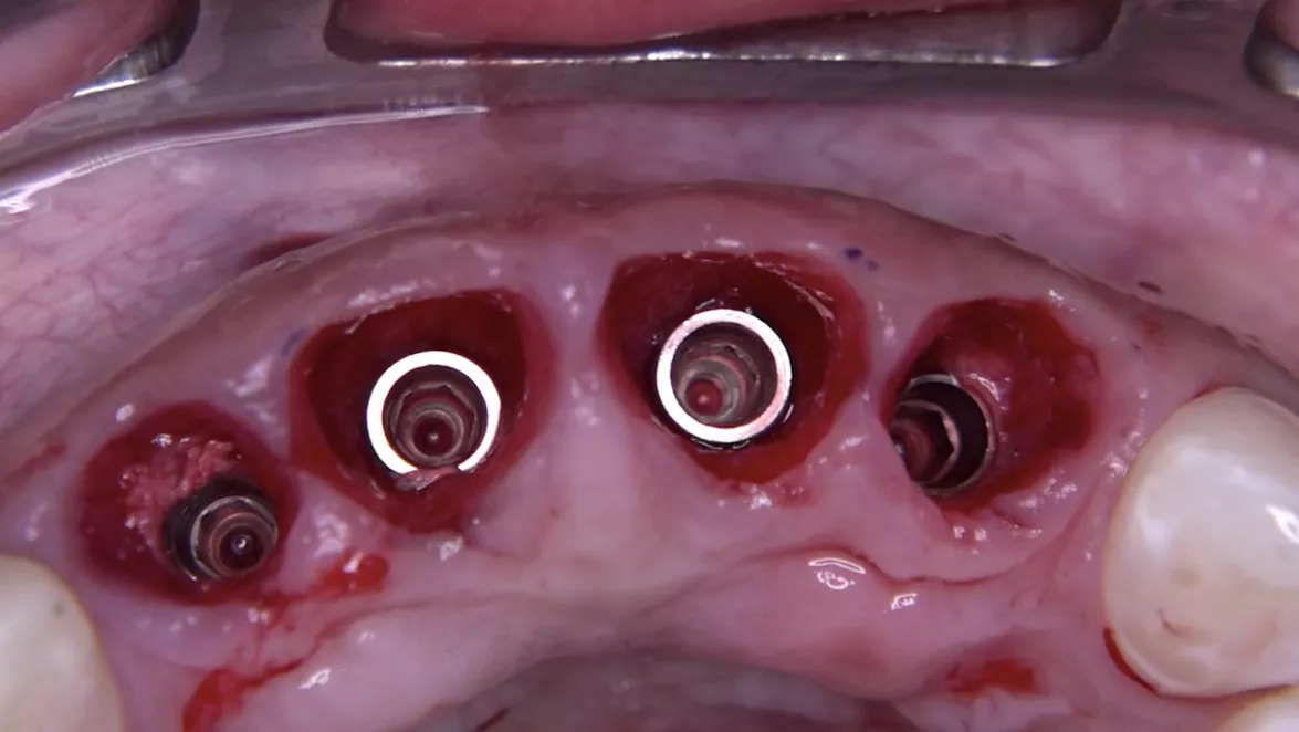 Final implant position