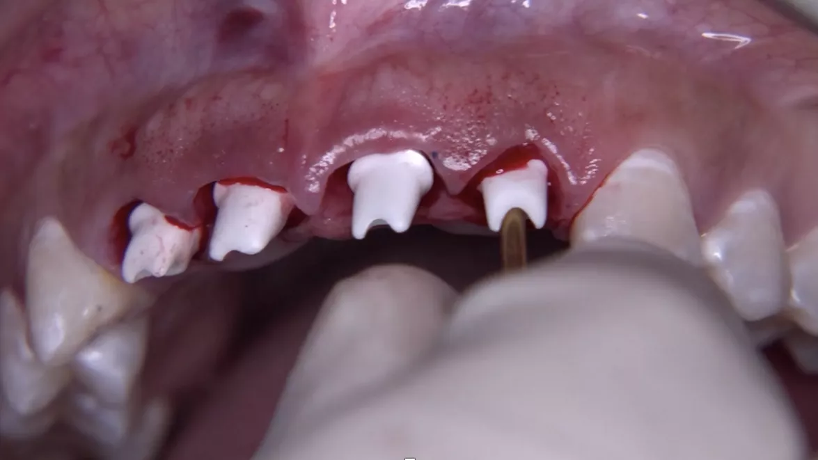 Customized zirconia abutments with Ti bases (produced prior to the surgery) positioned to adapt the temporary crowns