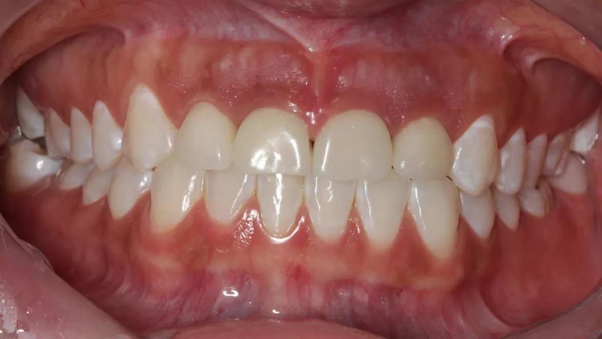 Clinical view of the provisionals five days after the surgery