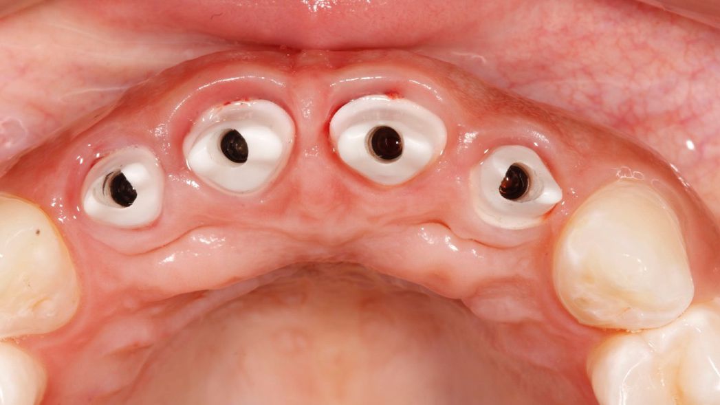 Occlusal view of the abutments six months after the surgery