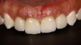 Buccal view of the definitive crowns six months after the surgery