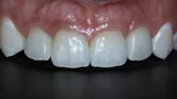 Buccal view of the case two years after the surgery
