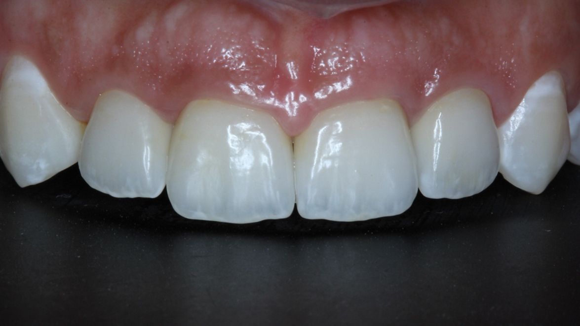 Buccal view of the case two years after the surgery