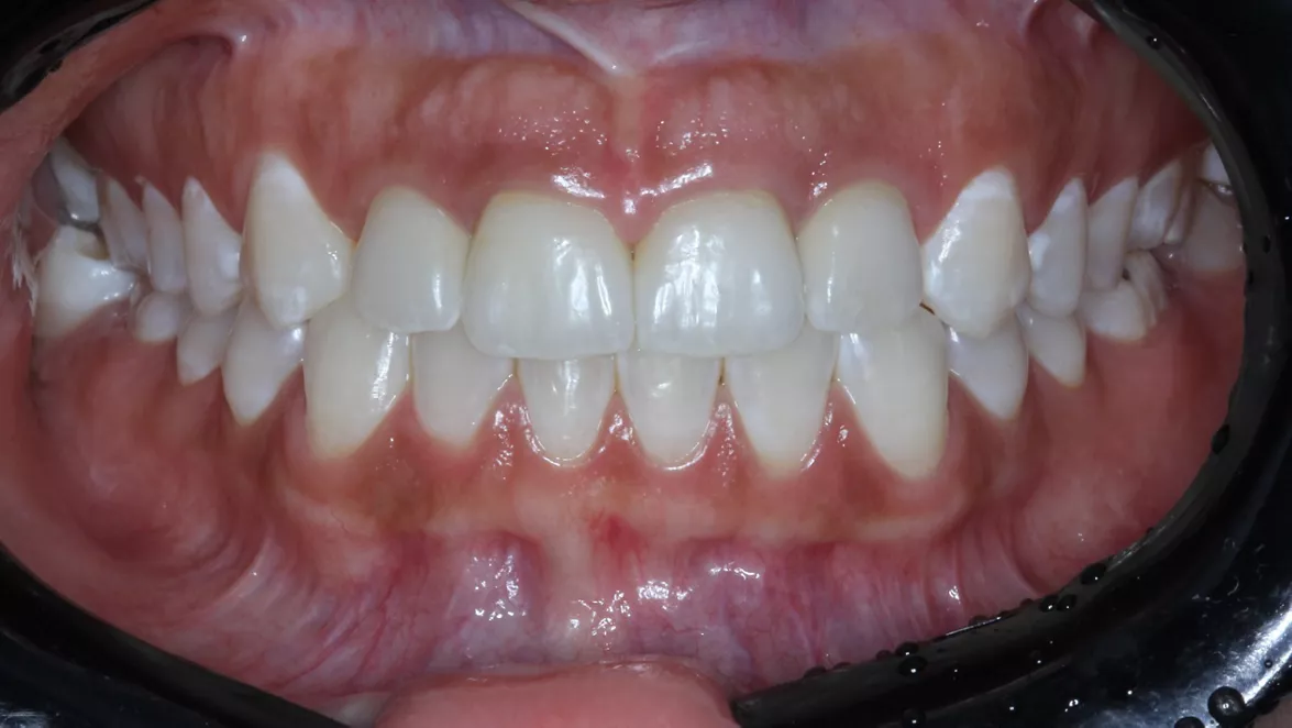 Occlusion in two Years follow-up