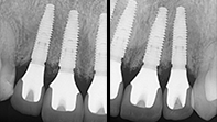 Periapical radiography in two Years follow-up