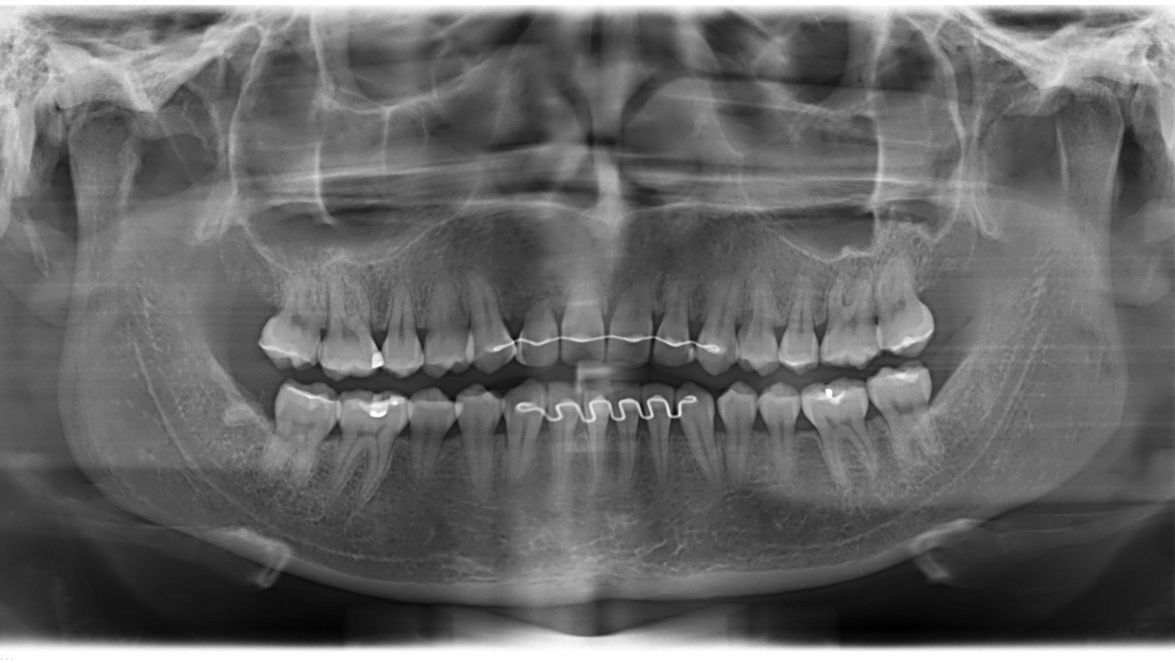Initial radiographic aspect of the case