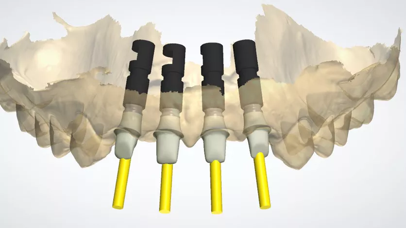 Design of the final zirconia customized abutment