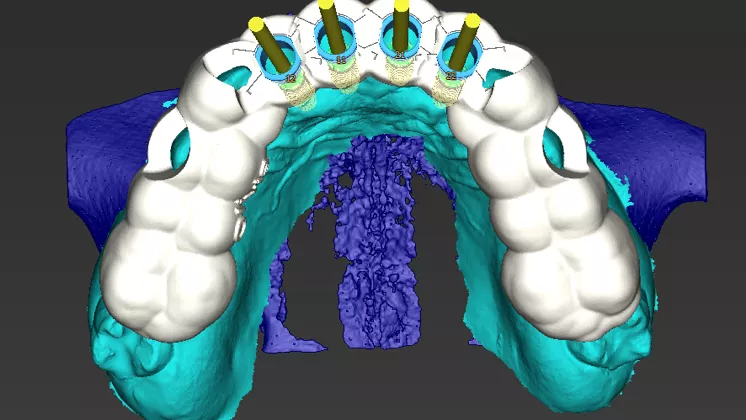 Guide with marks for the implant final position
