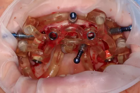 Neodent Clinical Case: Freehand Zi Ceramic Implant Rehabilitation