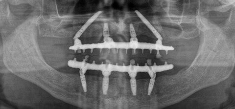 Neodent Clinical Case: Full Arch Solution With Immediate Loading