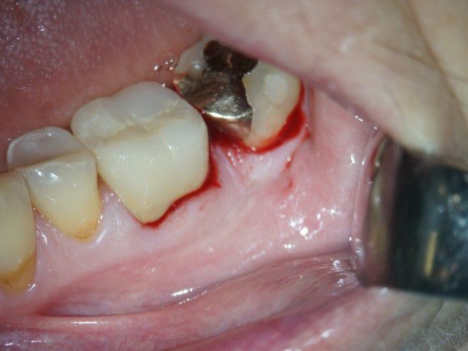 Bild zu Schnittführung gemäss dem M-MIST Verfahren mit simplified papilla preservation (ssp).