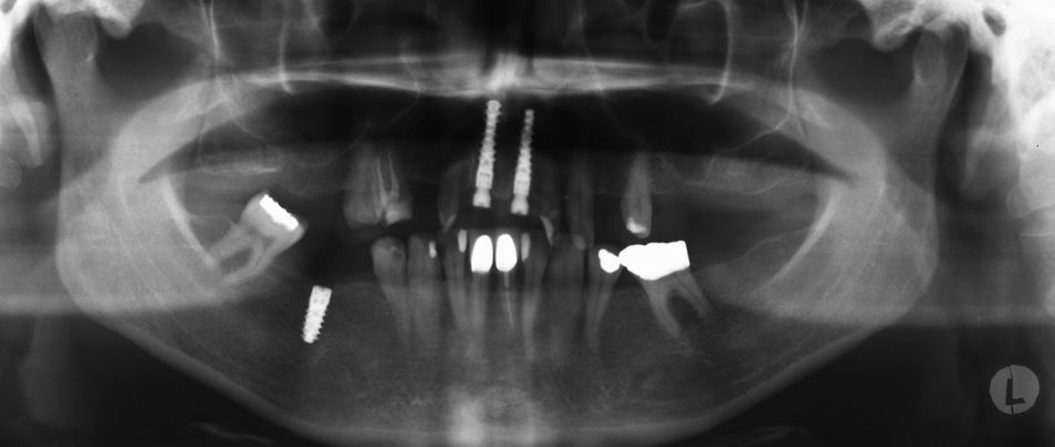 Abb. 10: OPG-Post OP