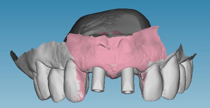 Abb. 12: Laborseitige Transferierung der Scan-Daten in Dental Wings Software