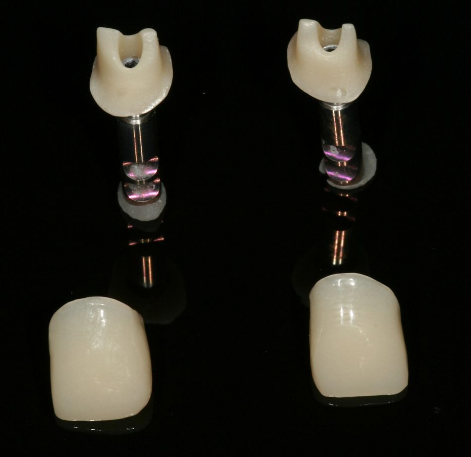Abb. 15: Chairside-Abutments, Composite-Kronen