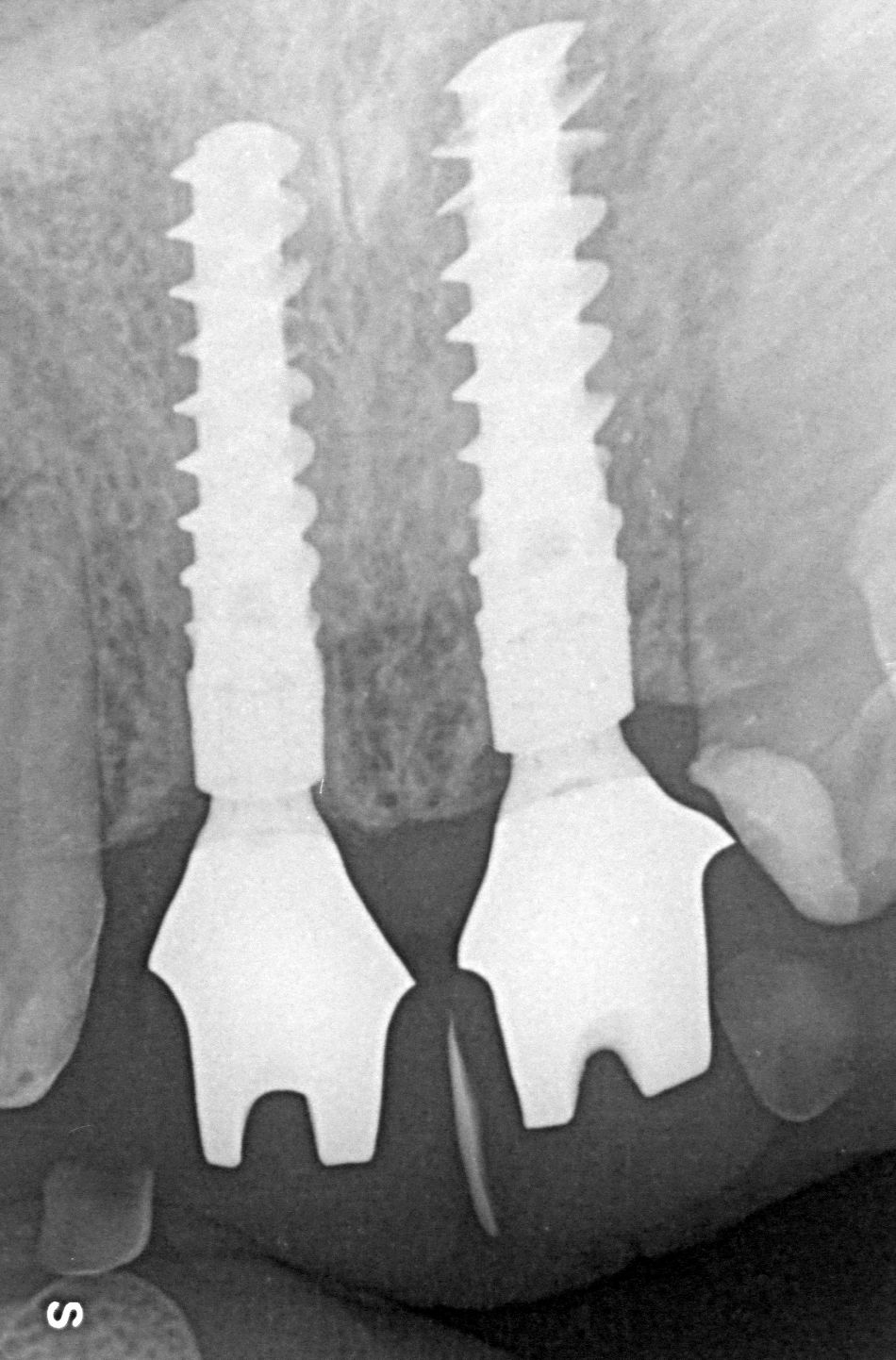 Abb. 20: Röntgenkontrolle der Osseointegration