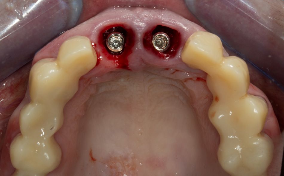 Abb. 9: Implantate regio 11 und 21 in situ, okklusale Ansicht