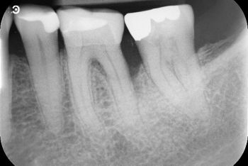 Knöcherner Defekt distal 36.