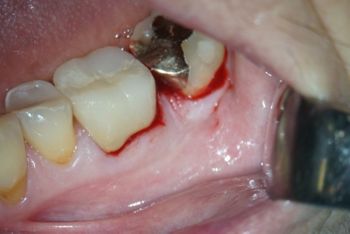 Schnittführung gemäss dem M-MIST Verfahren mit simplified papilla preservation (ssp).