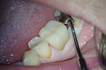Sondierung von 36 nach Hygienephase.