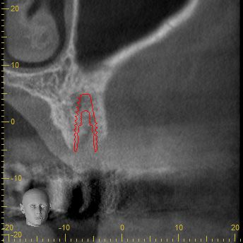Abb. 2b: Implantatplanung koronale Ansicht