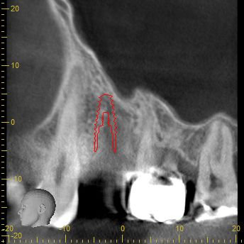 Abb. 3: Implantatplanung sagittale Ansicht