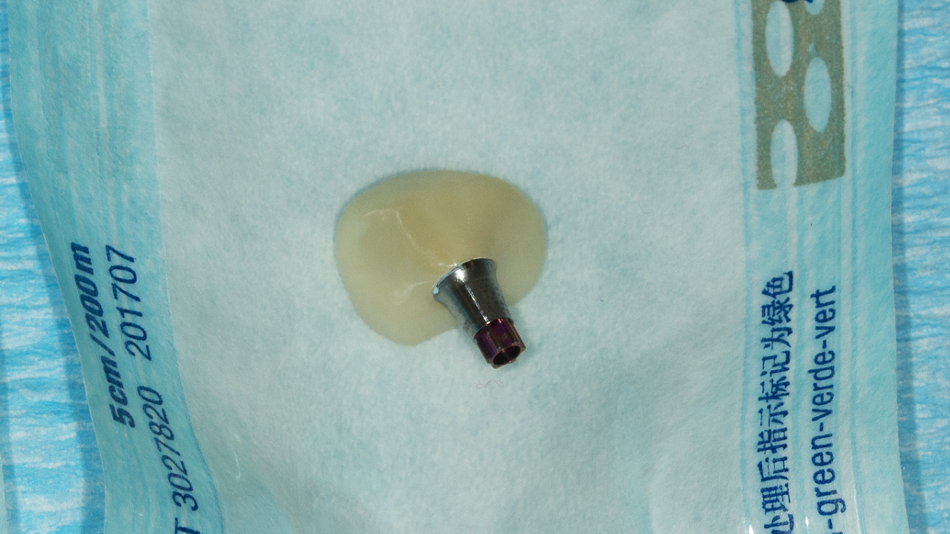 Abb. 10: Sealing-Socket-Abutment: sterilisiert
