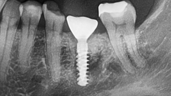 Abb. 15: Röntgenkontrolle 6 Monate Post-OP