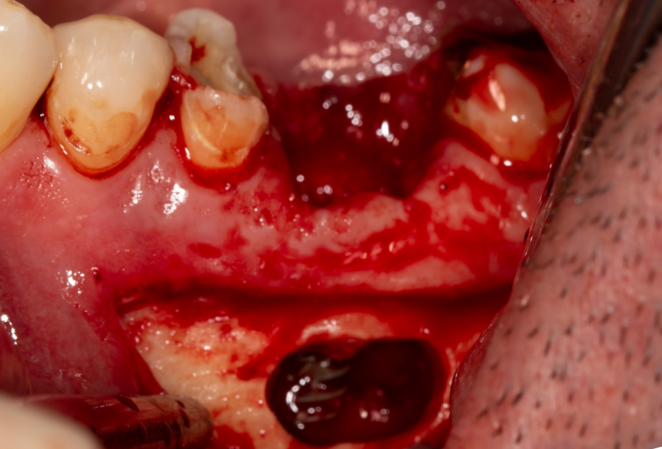 Abb. 5: OP-Situs: Z.n. Implantation