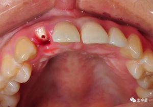 【病例分享】上颌侧切牙即刻种植美学修复一例
