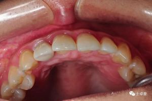 【病例分享】上颌侧切牙即刻种植美学修复一例